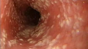 霉菌性食道炎,病因、症状与防治策略